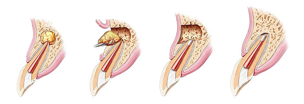 Postup resekcie koreňového hrotu zuba