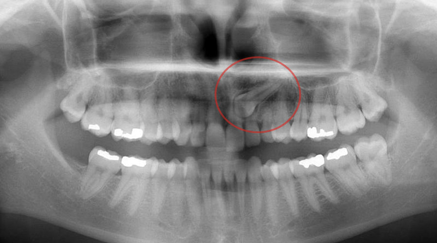 Retinovaný zub