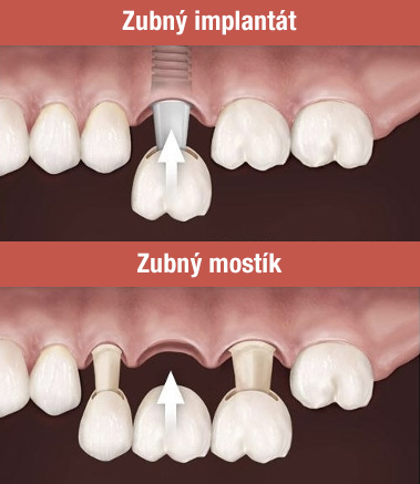 Porovnanie zubny implantat vs zubny mostik