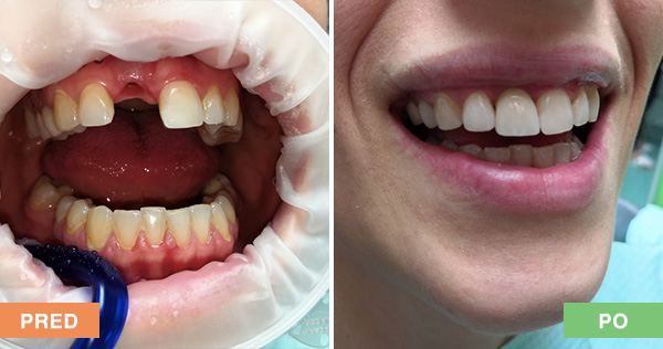 Nahradenie zubu zubným implantátom a korunkou